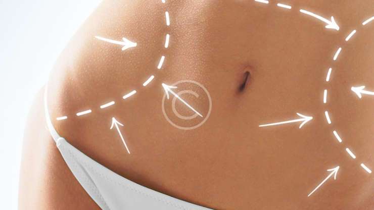 Remodelación corporal